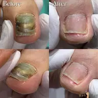 【足の分厚い爪・深爪再生補正】思わず隠したくなるその爪…😢諦めないでください🌈正常な爪へ再生致します💁♀️