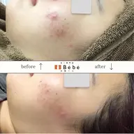 おかえりクーポン【再来】前回のご予約から3週間以内のご予約の場合、割引あり!お顔全体を吸引