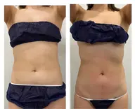 ミニモ限定【お腹痩せ】ダイエットマシンで頑固な下腹部/燃焼！まで燃1回でも効果有!