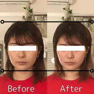 【コスパNo. 1👑 】ちょっとセレブな美容鍼🏝初回限定 《美顔コース》 ▷美顔鍼▷美顔矯正▷小顔調整▷炭酸ミスト