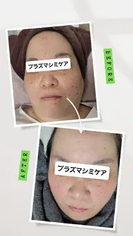 プラズマ+シミケア+水素パック　今あるシミをケアしながらお顔全体をケア。￥9800→￥8000