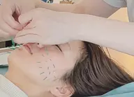 【来店2回目〜】EMS美容鍼