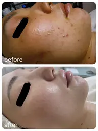 20代に人気✨《ニキビなかったことに！》本気のニキビケアコース2回体験　[大阪城北詰駅/京橋駅]