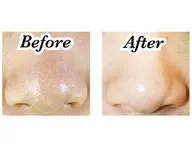 【毛穴ふわもこ洗浄】マスクによるお肌トラブル！ニキビ肌に！毛穴スッキリお掃除✨お化粧ノリもばっちり👌🏻♪