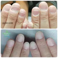 噛み癖や毟り癖のある方に☆深爪ケア