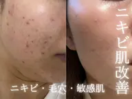 4月限定☘️リピートNo.1🆘エンビロン肌管理✨最先端美肌ケア🌿ピーリング,レチノール導入［赤み/ニキビ/毛穴］