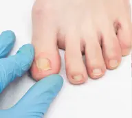 フット/巻き爪ケア1本