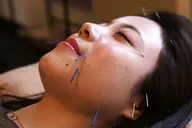 セルホワイトニング&美容針30本コース