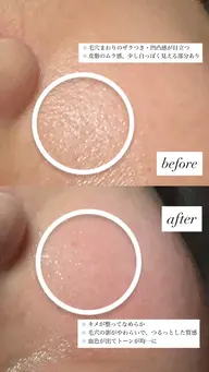 《マシュマロ肌ケア》赤み、乾燥、敏感肌 ¥8,800 → ¥3,500ハイドロ毛穴洗浄＋ヒト幹細胞＋特殊パック