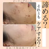 ニキビ肌改善コース