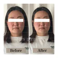 【3名様限定】美骨小顔矯正モニター募集♡