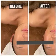 革新的ラジオ波（winback ）