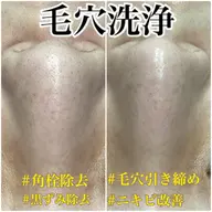 毛穴洗浄コース