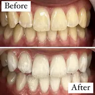 【継続ケアを考えてる方へ】5分照射×6回💥照射パワー2倍のセルフホワイトニングで白い歯へ🦷