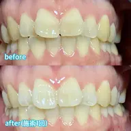 セルフホワイトニング