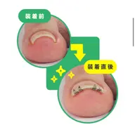 巻き爪矯正リフトコース　2本分(両親指)