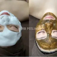 人気No.1👑《ニキビ/シミケア》メディカルハーブピーリング🌿剥離なしで陶器肌✨