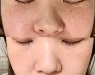 新メニュー【ホワイトラボ🫧】シミ・そばかす・肝斑でお悩みの方へ🌷※15分取り放題　ホワイトニング15分無料照射🎁