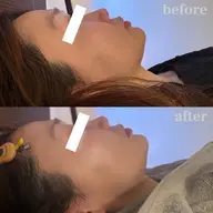 ムダ毛角質スッキリ🧤【全顔WAX脱毛】