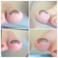 【モニター募集】フット巻き爪矯正¥12000→¥6000