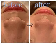 【毛穴エクストラクション】内容⇒ディープクレンジング⇒毛穴洗浄⇒毛穴エクストラクション⇒極上パック⇒高保湿仕上げ