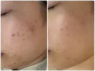 【人気No.2】ニキビ ニキビ跡 毛穴 どんなお悩みの方も◎剥けないハーブピーリング 90分 ¥25300→¥9800