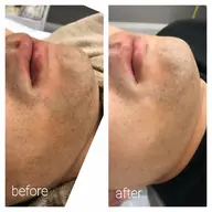 メンズ脱毛❇️ヒゲ集中コース