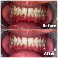 【 頑固な着色もMax40分照射で強力集中ケア 】🔹高濃度ハイパワーホワイトニング〈 40分照射 〉🔹