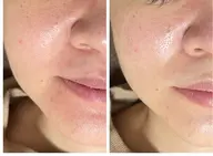 お顔毛穴エクストラクション