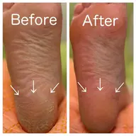 【最新技術】甘皮ケア+ゴワゴワ・カサつきかかと最強フットケアコース¥9350