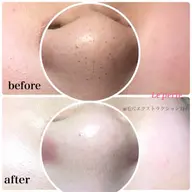 ごっそり毛穴角栓★徹底除去 毛穴エクストラクション（鼻のみ）➕生パック