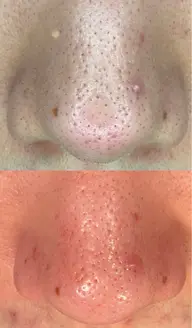 毛穴エクストラクション