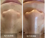 毛穴大掃除!毛穴の汚れを浮き出して、ツルツルにしませんか?