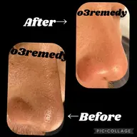 毛穴ケア（毛穴エクストラクション）