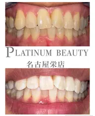 【ペア割引ホワイトニング】セルフホワイトニング〈30分照射〉