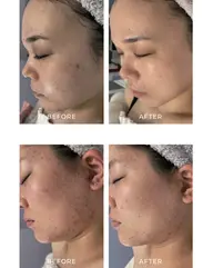 【期間限定‼️】仮予約【韓国ハーブピーリング🌿剥離あり】ニキビ、ニキビ跡、シミ、毛穴などあらゆる肌悩みにアプローチ◎