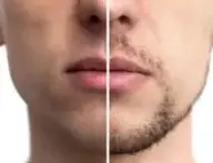 メンズひげ脱毛