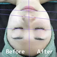 リフトアップ✨光フェイシャル