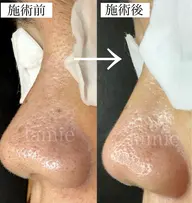 毛穴改善コース