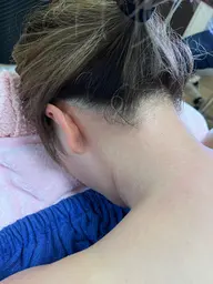 シュガーリング脱毛　うなじ​〜​肩甲骨周り