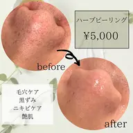 【剥離なし】毛穴悩み改善&ニキビケアに◎　ハーブピーリング ¥5,000→¥3,980