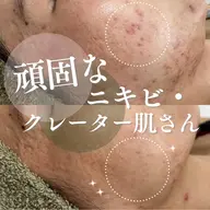 【頑固なニキビ・クレーター肌さん】剥けないハーブピーリング＋セレクト美容液３種＋ipsp幹細胞仕上げ　定価26,950円