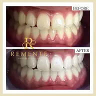 【✨口コミ記載の方80%OFF！✨】お試し セルフホワイトニング照射パワー100%！たっぷり30分間照射‼️