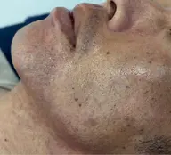 メンズ脱毛　ヒゲ