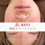 定番♪陶器肌【剥けないハーブピーリング】オプション1つプレゼント♪70分