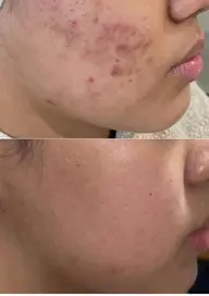 ハーブピーリング 女性