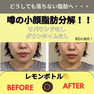 【結果重視】最新マシンで導入レモン ボトル【横顔美人】キレイなフェイスラインへ!フェイスマスクつき