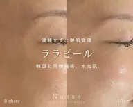 渡韓しなくても叶う艶肌管理☆ララ ピール＋専用ゲルパック＋美容液導入付