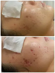 【ニキビ跡ケアに最強、30日急速肌再生✨】5年あったニキビが😲レチノールピーリング1ヶ月✖️5回