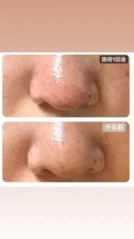 エステ 【エクストラクション毛穴洗浄エステ】